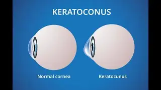 Keratoconus (Bulging of Eye Cornea into a cone shape) ; Causes, Symptoms, Diagnosis, Treatment