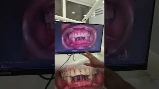 Don&rsquo;t remove a tooth without a replacement plan!  #dentalclinic