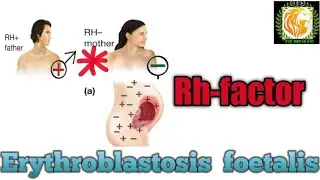Rh -factor : Erythroblastosis foetalis