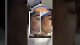 At Influennz Skin & Hair Clinic, led by AIIMS‑trained dermatologist