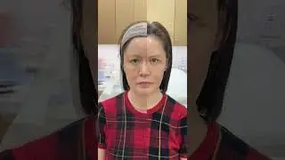 Periorbital Filler Transformation | Youthful Eyes with No Surgery! 🔥