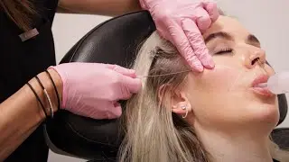 Thread Lift Treatment