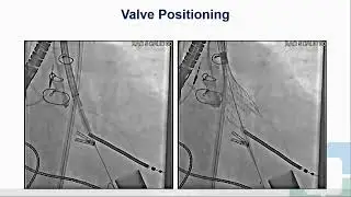 Ss9 Self Expanding Valve for Aortic Insufficiency Freemedbooks.com