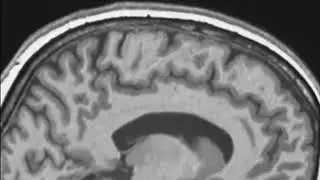 Brain Shift in Space: Astronauts' Brains Physically Reposition During Flight