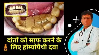 Unlock the Secret Homeopathy Medicine for Clean Teeth |