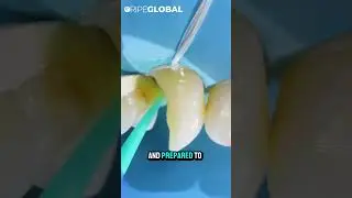 How to Deal with Dark Dentine | Tips & Tricks with Dr. Lincoln Harris