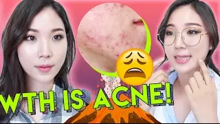 😫 What Is Acne and How To Treat Acne with Skincare Products 🌴 Liah Yoo