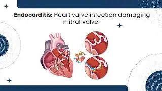 Mitral valve repair