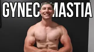 6 YEARS LATER | GYNECOMASTIA SURGERY RECOVERY UPDATE!