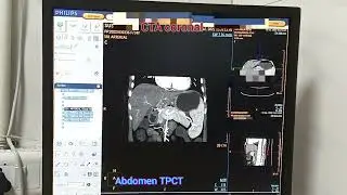 AbdomenTriple phase | CT scan abdomen angiography | CTA #ct_scan #videos  #trending abd #philips