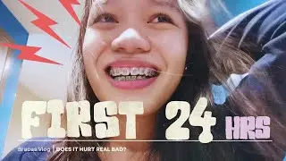 My FIRST 24HRS with BRACES!