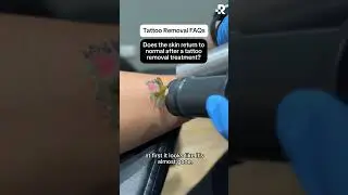 Most Common Tattoo Removal Questions | Removery