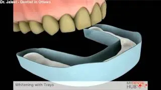 Esthetics And Restorative - Whitening With Trays - Ottawa Dentists