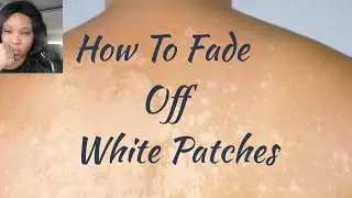 How To Fade Off White Patches | hyperpigmentation | white Patch Treatment