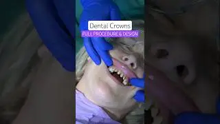 Procedura zakładania korony zębowej krok po kroku (PEŁNA PROCEDURA I PROJEKT) #dentalcrowns #crowns