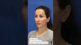 From 51 years old back to 24 again... Facelift Before & After