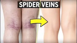 I Found the ULTIMATE Spider Veins Remedy Actually Works! 🔬#SpiderVeins #veintreatment #bodylab #yt