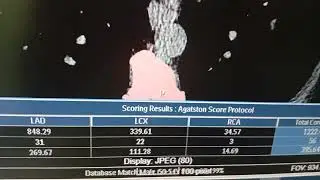 Coronary CT , Calcium Score , Coronary MPR 