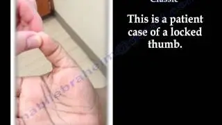 locked Trigger Thumb Classic - Everything You Need To Know - Dr. Nabil Ebraheim