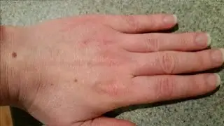 how to get rid of hand wrinkles naturally in a few minutes