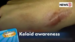 HEALTH CHECK: Keloid scars, dapat bang ikabahala?