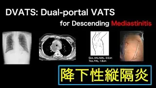 【#134】縦隔炎。DVATS: dual-portal VATS for acute descending mediastinitis