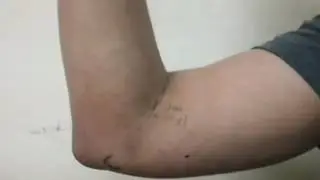 How to palpate epitrochlear lymph nodes. Clinical examination video by SIMPLE Orthopaedics
