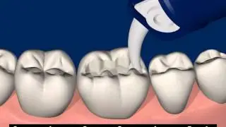 Universal adhesive Futurabond U-Part 7/12: Protective varnish for glass ionomer cement restorations