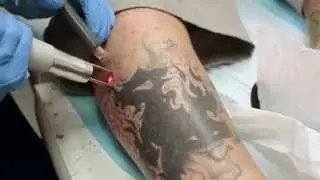 Tattoo Nightmares' Big Gus Gets Laser Tattoo Removal Treatment