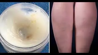 Cum se prepară o cremă de usturoi și lăm&acirc;ie pentru a elimina varicele