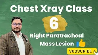 Chest Xray Classes #6 (Right Paratracheal Swelling)#xray #tb 