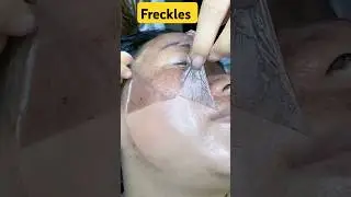 What are freckles and how to get rid of them? #freckles #shorts #dadumedicalcentre