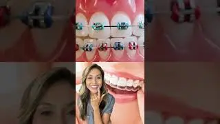 Pros and Cons of Braces vs Invisalign