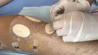 refection Pansement chirurgie du Ligament Croisé Antérieur