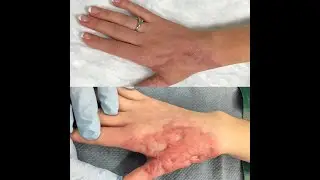 Burn Scar Combination Treatment | Old Burn Scars | Best Scar Treatment in India | Kayakalp Laser