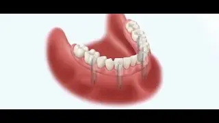 AetM Groupe &ndash; Pose de bridge complet sur implants &agrave; Ermont (95)