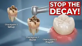 Don&rsquo;t Fear the Drill: The 3D Truth About Cavity Treatment and Dental Fillings