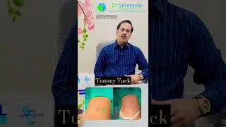 mommymakeover#liposuction| best plastic surgeon in andhrapradesh