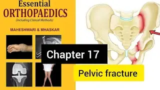 Pelvic fracture | In Hindi |  #physiotherapy #orthopedic #fracture #essentialorthopedics 