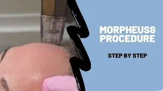 Morpheus8 - Step by Step Procedure Breakdown