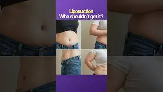 Who Should Avoid Liposuction? Questions About Abdominal Liposuction for the Severely Obese