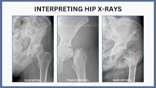 Interpreting Hip X-Rays