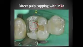 Class 2 and direct pulp capping with CRF