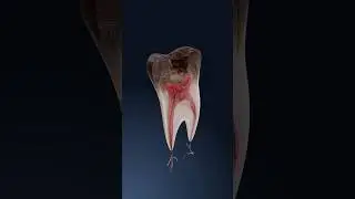 How cavities form: a 3D look at tooth decay progression