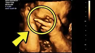 Mom Thinks She&rsquo;s Pregnant With Twins, Doctor Freezes When He Sees Her Ultrasound