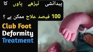 Club Foot Deformity Treatment and Physiotherapy exercises||پیدائشی ٹیڑھے پاوں کا مکمل علاج اور ورزش 