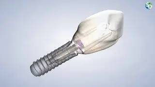 Dental Implants: Everything You Need to Know | San Diego, CA