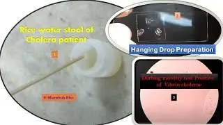 Rice water stool and  Darting motility test Positive of Vibrio cholerae Demonstration