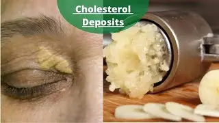 How to Remove the Cholesterol Deposits Around Your Eyes || Natural Remedies