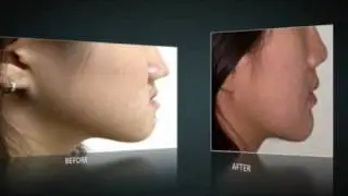 Why the long face? Amazing Makeover of a teenager with long face and protruding jaw.